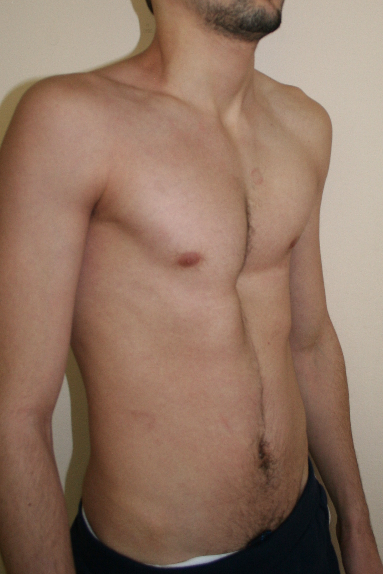 воронкообразная грудь у мужчин фото 26